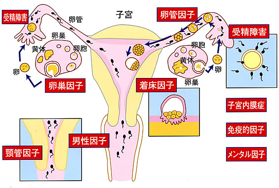 女性不妊症の原因